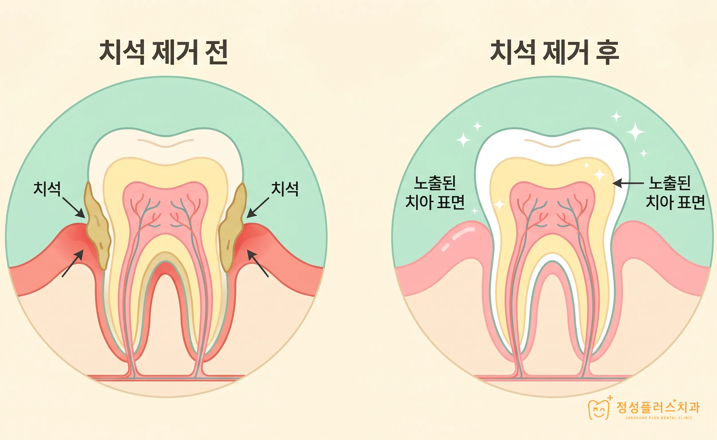 화곡 치과 양치할 때 찬물이 닿으면 소름 끼치게 시린 이유가 있습니다.